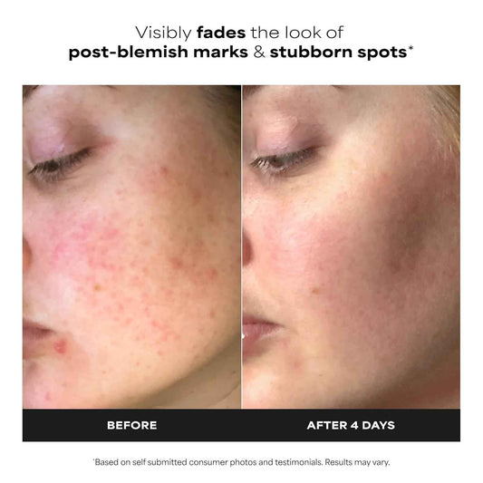 Paula's Choice BOOST 10% Azelaic Acid Booster Cream Gel Face Serum with Salicylic Acid, Oil-Free Skin Brightening Serum for Face, Fragrance-Free