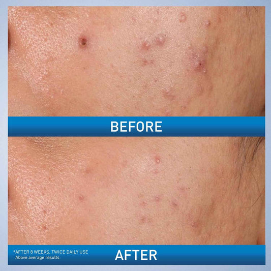 CeraVe Acne Control Gel, 2% Salicylic Acid Treatment With Glycolic Acid + Lactic Acids + Niacniamide, Acne Gel Helps Clear Blemishes Without Over Drying, Alcohol Free & Oil Free, 1.35 Fl Oz