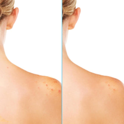 Differin_Acne_Body_Spray,_Acne_Treatment_with_Salicylic_Acid_by_the_makers_of_Differin_Gel,_360_Formula_for_Back_Acne,_Chest_and_Shoulders,_6_oz