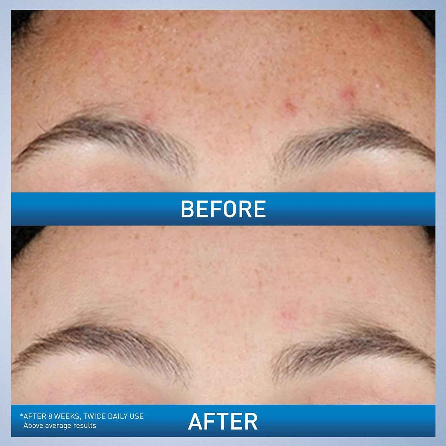 CeraVe Resurfacing Retinol Serum For Post Acne Marks, Formulated With Licorice Root Extract & Niacinamide, Brightening Serum & Pore Minimizer For Face, Post Acne Skin Barrier Repair, Non-Comedogenic
