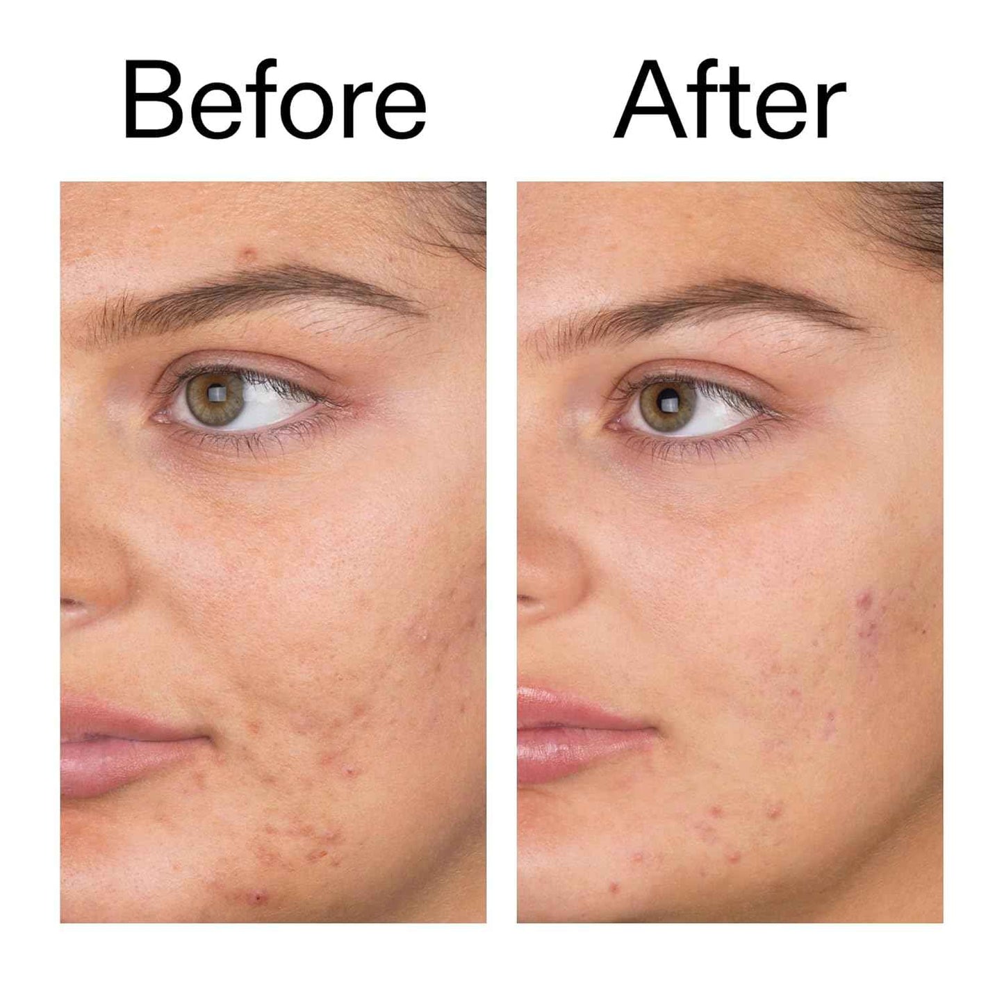 The INKEY List Salicylic Acid Cleanser - Daily Exfoliating Cleanser with 2% Salicylic Acid & Zinc PCA, Unclogs Pores, Anti Acne, Reduces Blackheads & Excess Oil for Clearer Skin