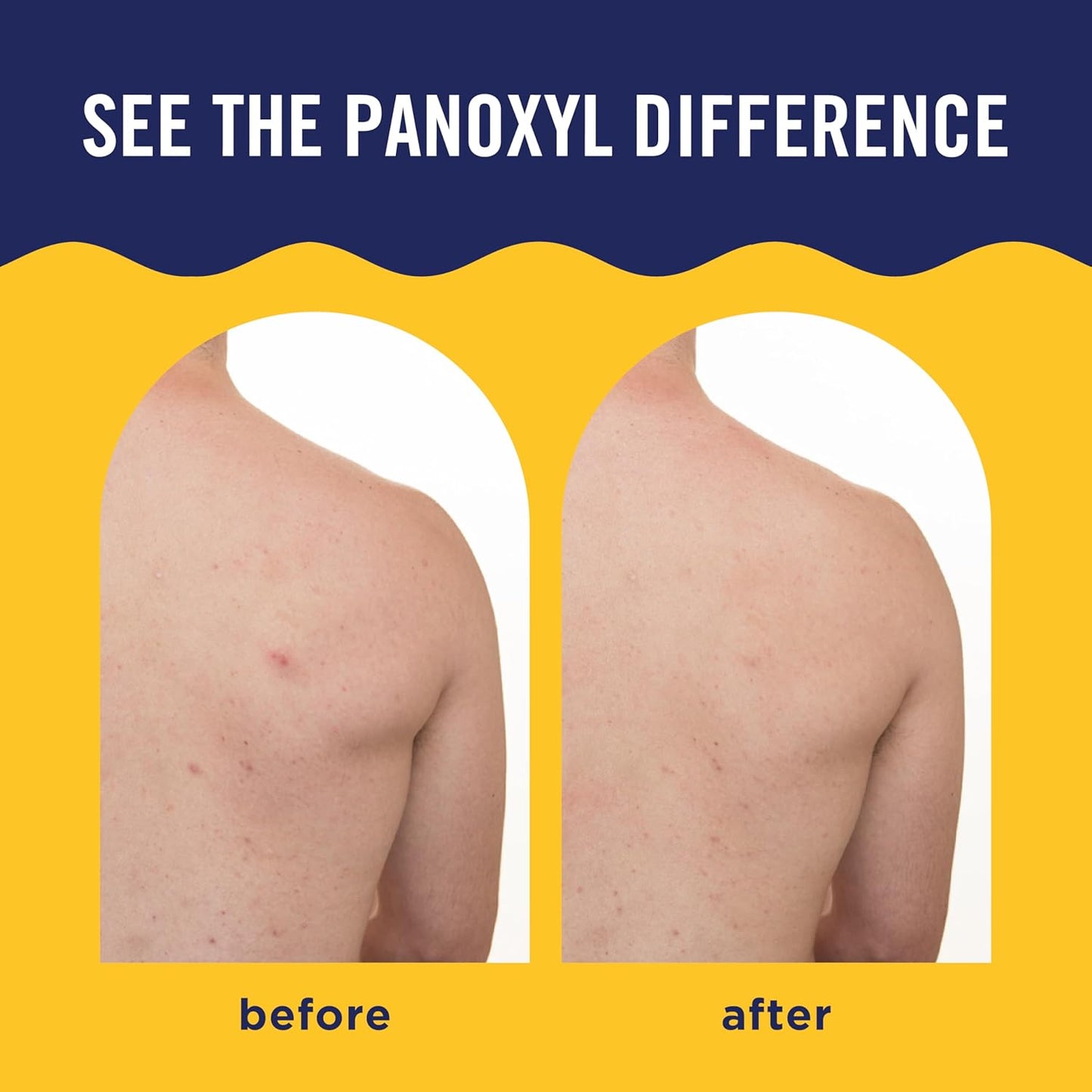 PanOxyl_Acne_Banishing_Body_Spray_with_2%_Salicylic_Acid,_Pimple_Treatment_Spray_to_Clear_Stubborn_Breakouts,_360-Degree_Spray_Nozzle,_Skin-Brightening_Niacinamide,_Vitamin_C,_Witch_Hazel,_Aloe,_6_Oz