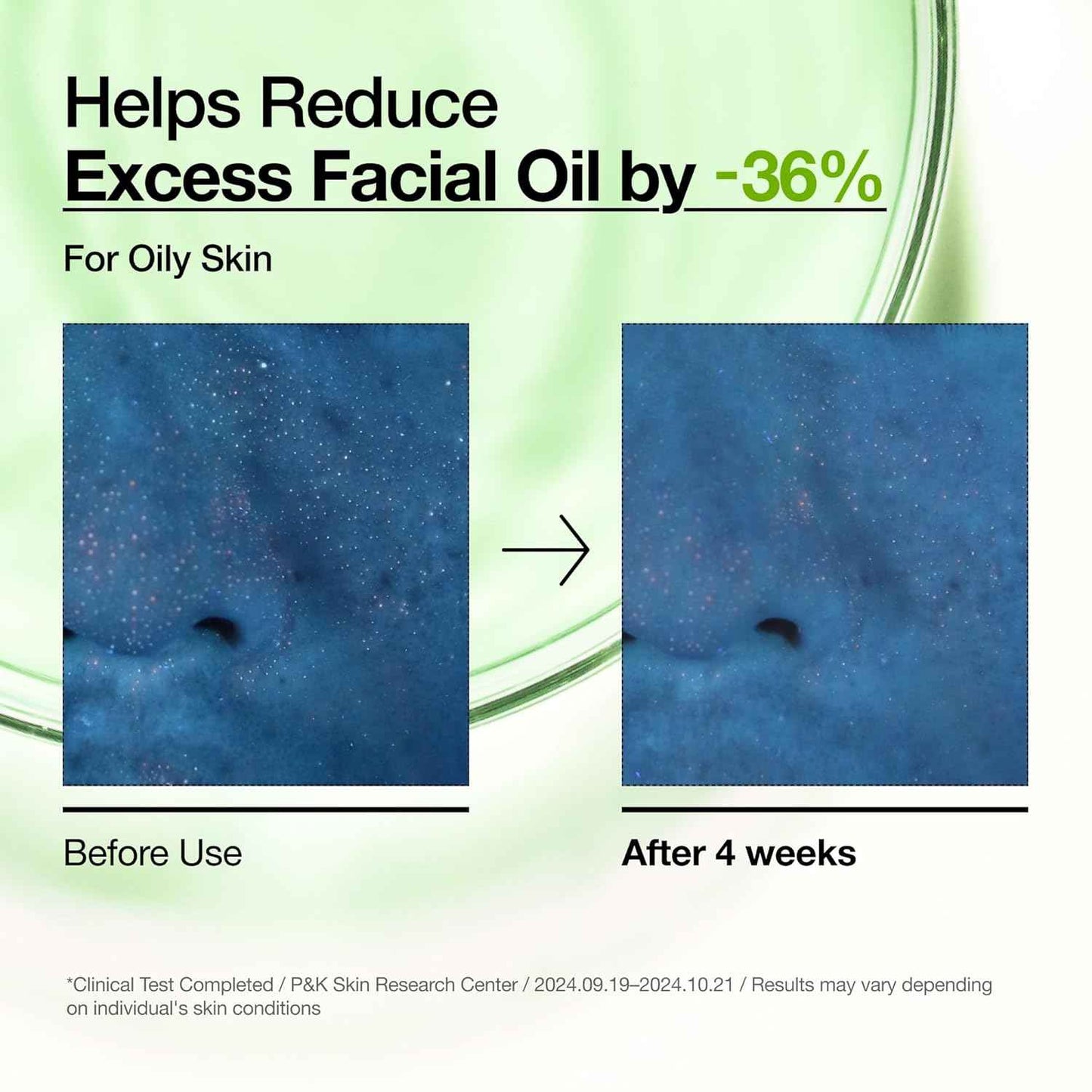 Anua Azelaic Acid 10 Hyaluron Redness Soothing Serum, Facial Serum for Blemish-Prone & Oily-Prone Skin, Lightweight & Hydrating Blemish Care, Hyaluronic Acid, Korean Skincare, 1.01 fl oz.