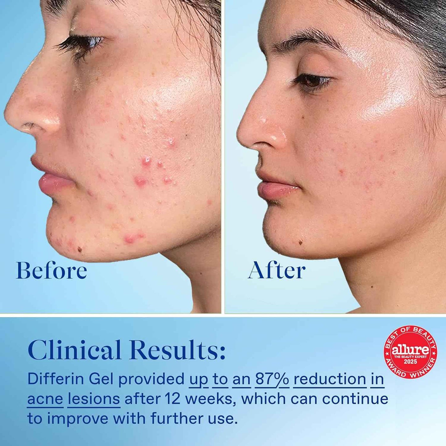 Differin Acne Treatment Gel, 90 Day Supply, Retinoid Treatment for Face with 0.1% Adapalene, Gentle Skin Care for Acne Prone Sensitive Skin, 45g Pump (Packaging May Vary)
