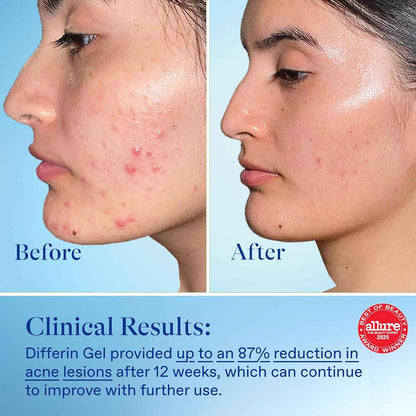 Differin Acne Treatment Gel, 30 Day Supply, Retinoid Treatment for Face with 0.1% Adapalene, Gentle Skin Care for Acne Prone Sensitive Skin, 15g Pump (Packaging May Vary)
