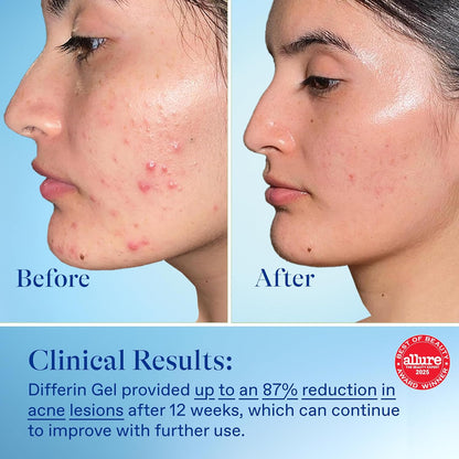 Differin_Acne_Treatment_Gel,_60_Day_Supply,_Retinoid_Treatment_for_Face_with_0.1%_Adapalene,_Gentle_Skin_Care_for_Acne_Prone_Sensitive_Skin,_15g_Tube_(Pack_of_2)_(Packaging_May_Vary)