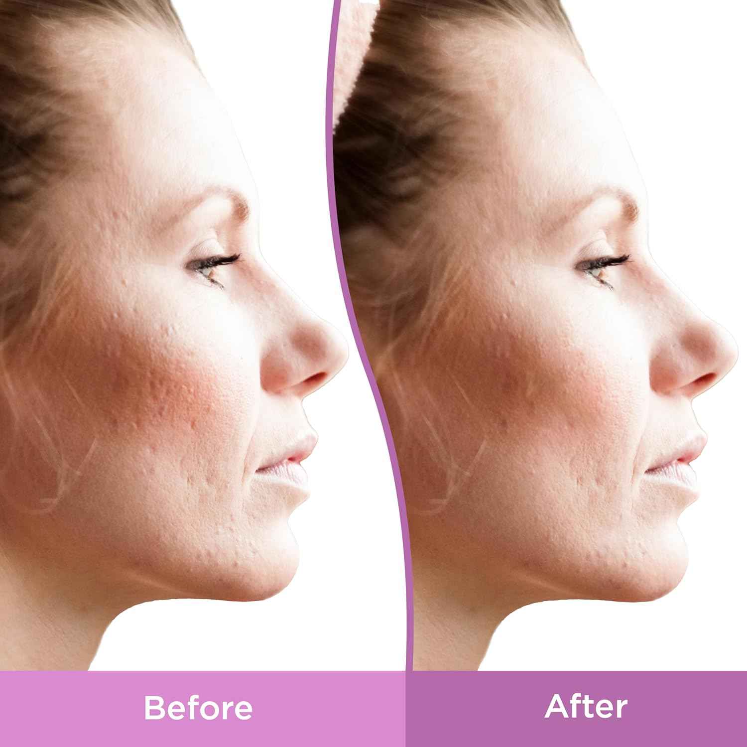 Differin Gel Acne Scar Spot Treatment for Face, Resurfacing Scar Gel, Gentle Skin Care for Acne Prone Sensitive Skin
