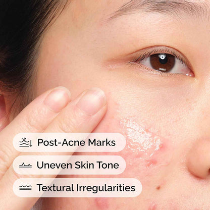 The Ordinary Aloe 2% + NAG 2% Solution, Soothes Skin and Targets Post-Acne Marks, 1 Fl Oz