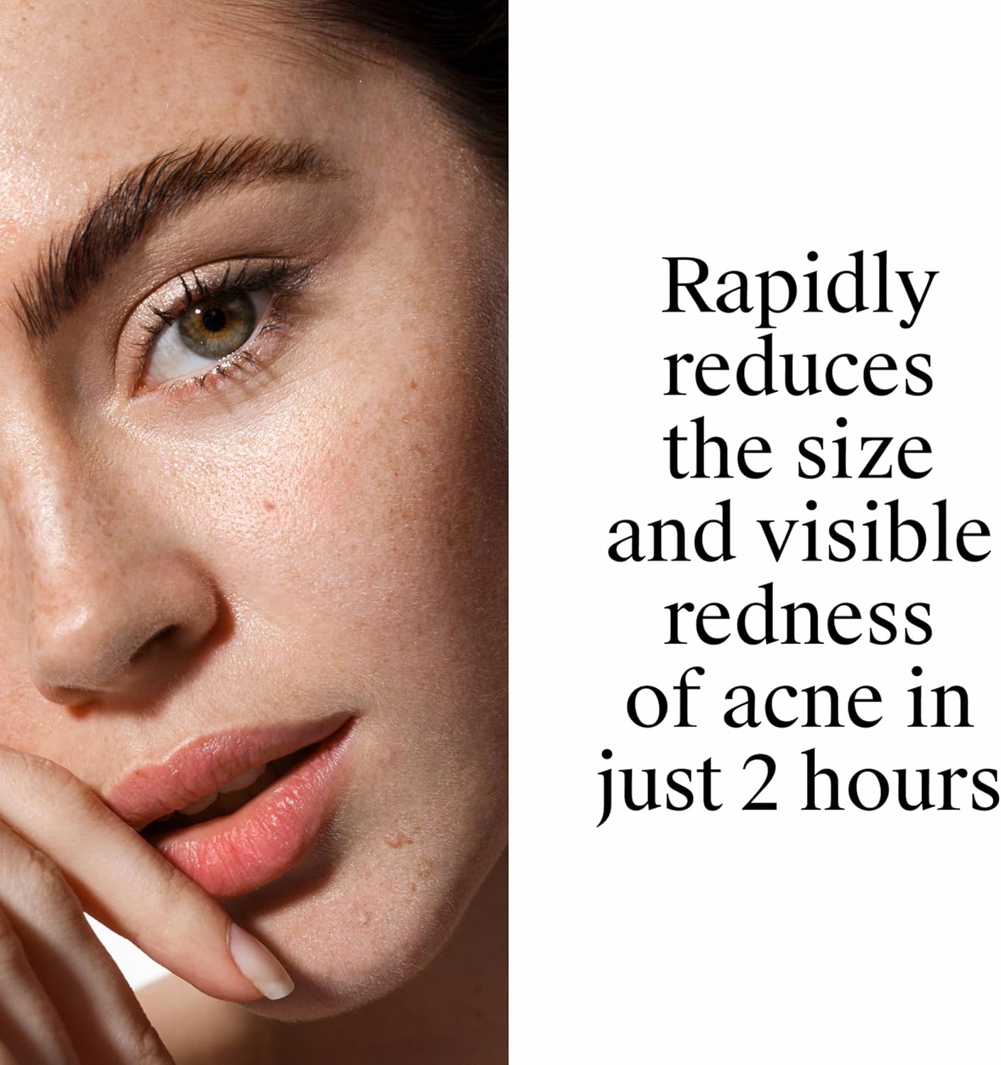 Neutrogena_Rapid_Clear_Stubborn_Acne_Spot_Treatment_Gel,_Maximum_Strength_10%_Benzoyl_Per-oxide_Treatment_Medication_for_Acne_Prone_Skin,_Pimple_Cream_Reduces_Size_&_Redness,_1_oz