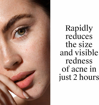 Neutrogena_Rapid_Clear_Stubborn_Acne_Spot_Treatment_Gel,_Maximum_Strength_10%_Benzoyl_Per-oxide_Treatment_Medication_for_Acne_Prone_Skin,_Pimple_Cream_Reduces_Size_&_Redness,_1_oz