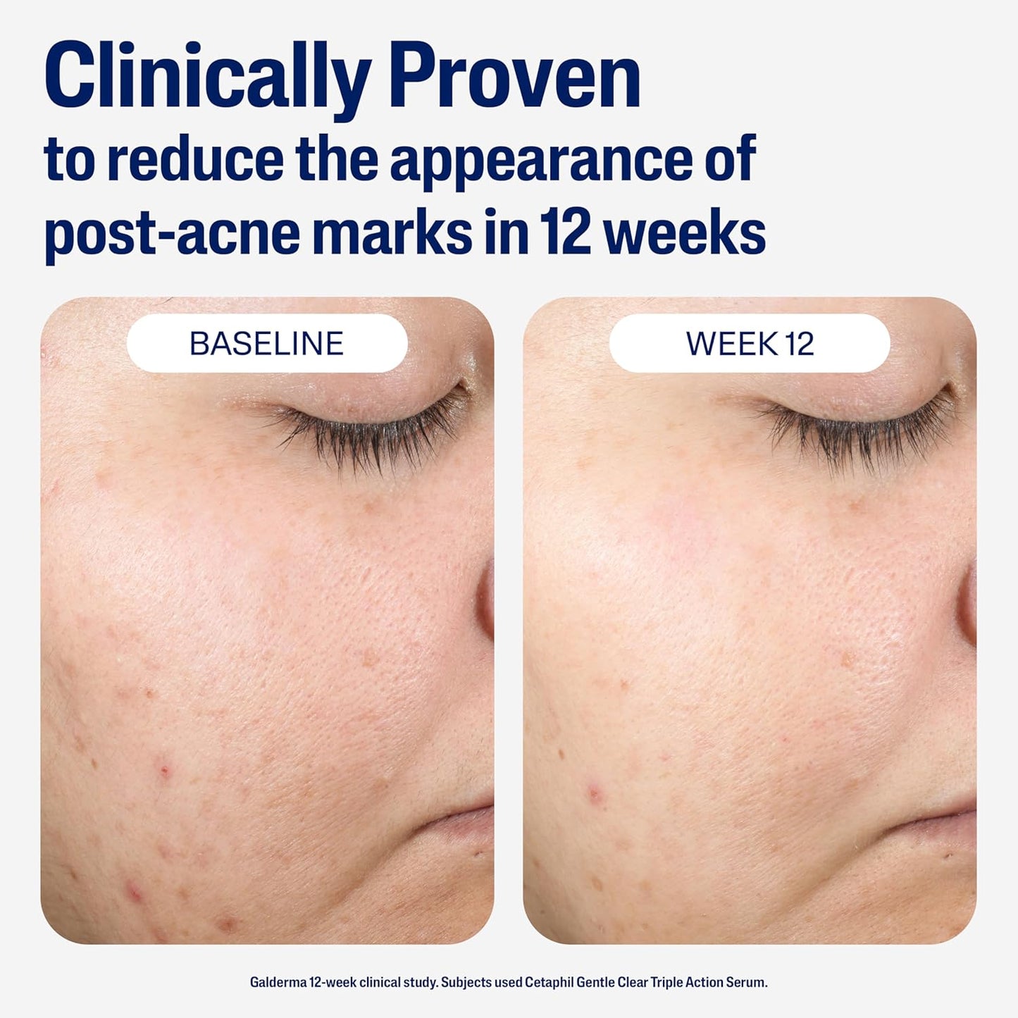 CETAPHIL_Gentle_Clear_Repairing_Post-Acne_Serum,_Retinol_Alternative,_Oil_Free_Serum_for_Sensitive_Skin,_1_Fl_Oz,_Bakuchiol,_Improves_Skin_Tone_&_Post-acne_Marks,_Dermatologist_Recommended_Brand