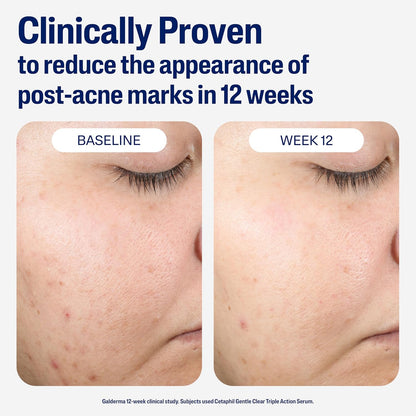 CETAPHIL_Gentle_Clear_Repairing_Post-Acne_Serum,_Retinol_Alternative,_Oil_Free_Serum_for_Sensitive_Skin,_1_Fl_Oz,_Bakuchiol,_Improves_Skin_Tone_&_Post-acne_Marks,_Dermatologist_Recommended_Brand
