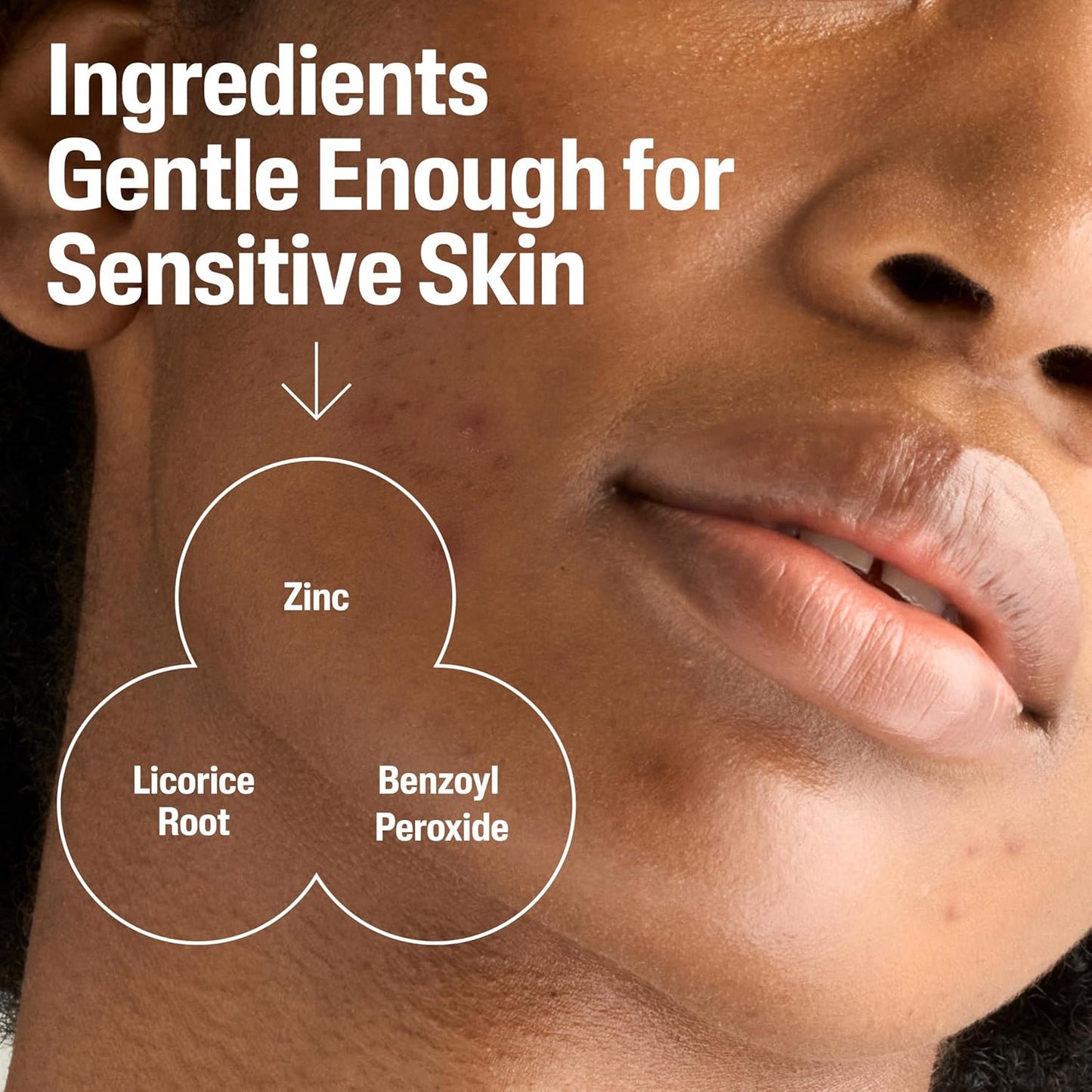Cetaphil_Gentle_Clear_Complexion-Clearing_BPO_Acne_Cleanser_with_2.6%_Benzoyl_Peroxide,_Creamy_and_Soothing_for_Sensitive_Skin,_Suitable_for_All_Skin_Types,_4.2oz
