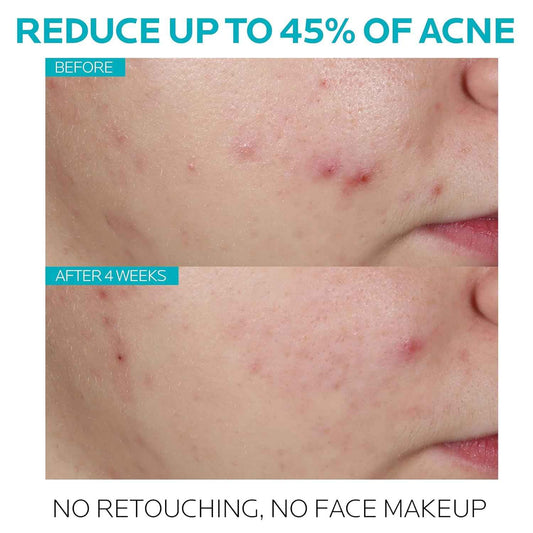 La Roche-Posay Effaclar 1.5% Salicylic Acid Serum, Acne Treatment For Face With Glycolic Acid & Niacinamide, Acne Serum Helps Clear Blackheads, Whiteheads, Pimples & Reduces Post Acne Marks