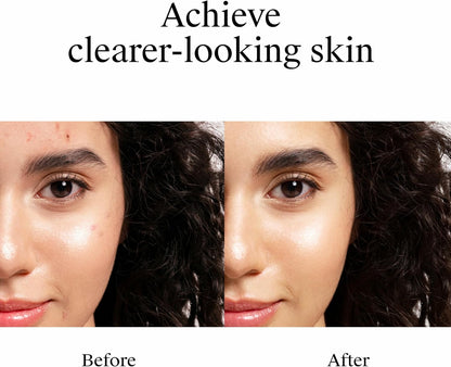 Neutrogena_Rapid_Clear_Stubborn_Acne_Spot_Treatment_Gel,_Maximum_Strength_10%_Benzoyl_Per-oxide_Treatment_Medication_for_Acne_Prone_Skin,_Pimple_Cream_Reduces_Size_&_Redness,_1_oz