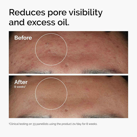 The Ordinary Niacinamide 10% + Zinc 1%, Smoothing Serum for Blemish-Prone Skin