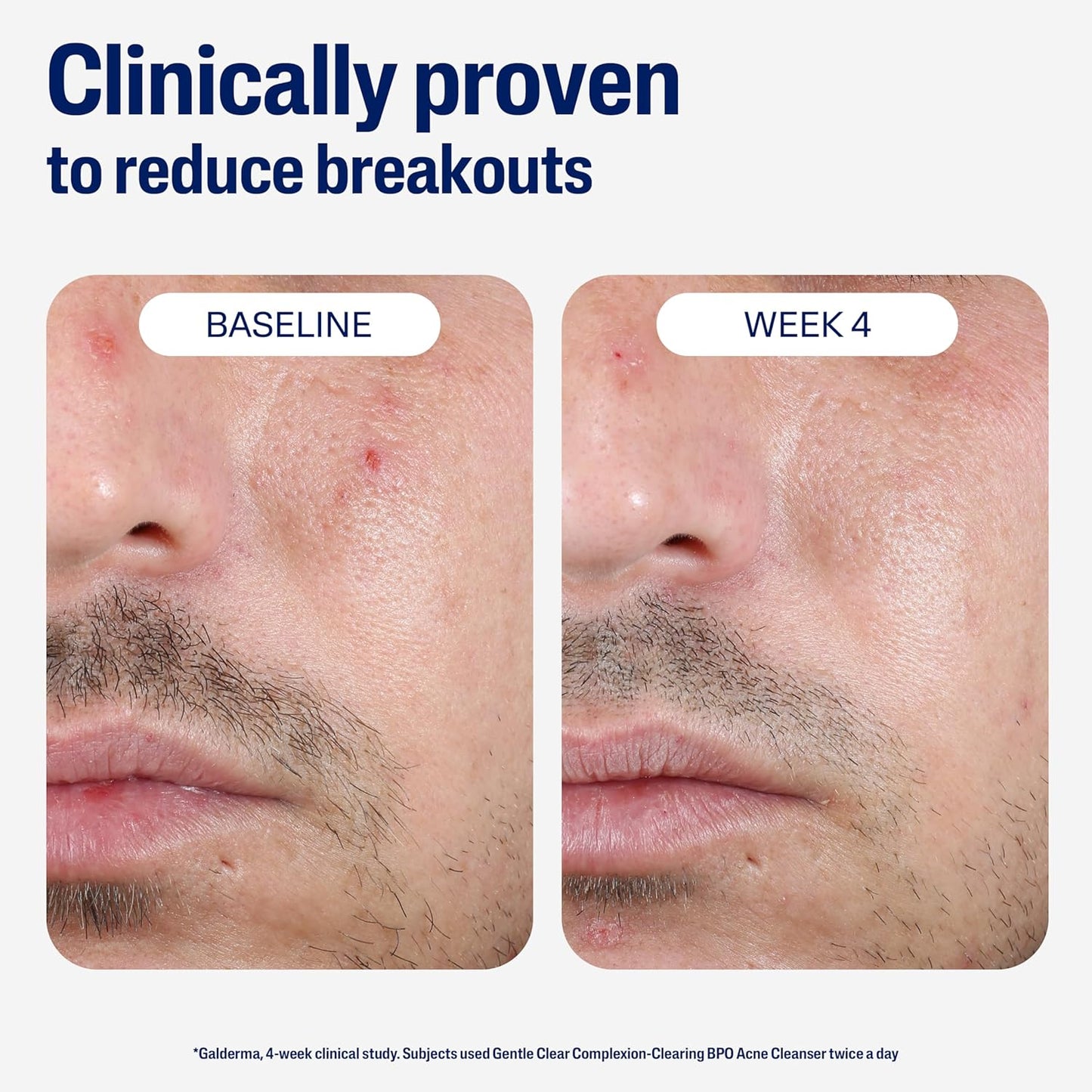 Cetaphil_Gentle_Clear_Complexion-Clearing_BPO_Acne_Cleanser_with_2.6%_Benzoyl_Peroxide,_Creamy_and_Soothing_for_Sensitive_Skin,_Suitable_for_All_Skin_Types,_4.2oz