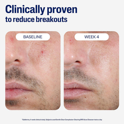 Cetaphil_Gentle_Clear_Complexion-Clearing_BPO_Acne_Cleanser_with_2.6%_Benzoyl_Peroxide,_Creamy_and_Soothing_for_Sensitive_Skin,_Suitable_for_All_Skin_Types,_4.2oz