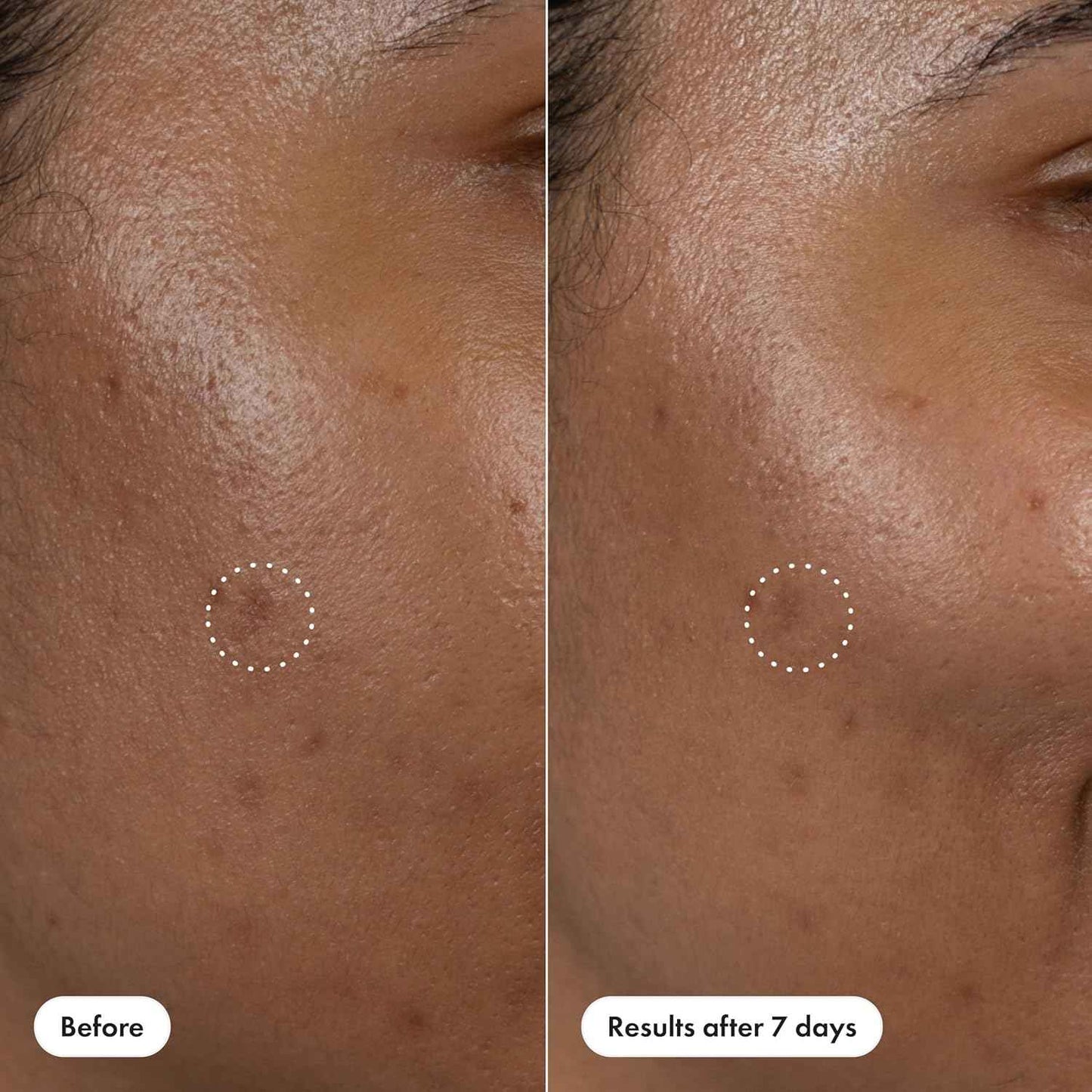 Hero Cosmetics Dark Spot Correct Spot-Fading 15% Vitamin C plus Hyaluronic Acid Serum. Improves the Look of Post Blemish Marks in 7 Days. Twist Applicator and Rollerball Tip for Easy Application. 10mL