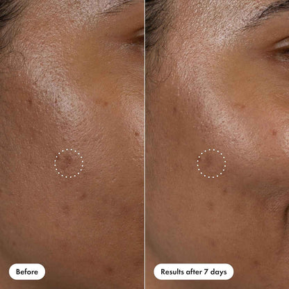 Hero Cosmetics Dark Spot Correct Spot-Fading 15% Vitamin C plus Hyaluronic Acid Serum. Improves the Look of Post Blemish Marks in 7 Days. Twist Applicator and Rollerball Tip for Easy Application. 10mL