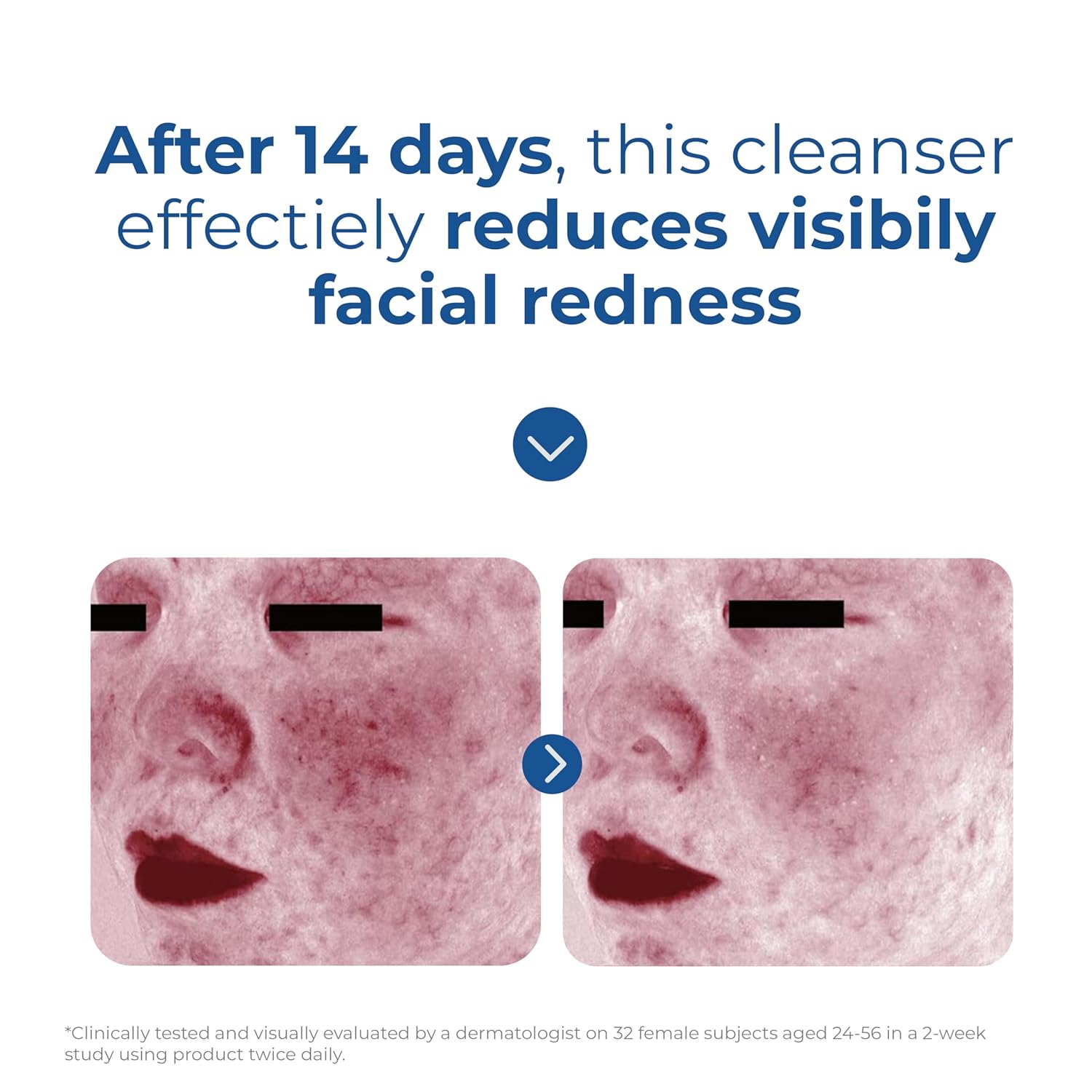 EltaMD_Skin_Recovery_Amino_Acid_Foaming_Facial_Cleanser,_Gentle_Face_Cleanser_for_Sensitive_Skin_and_Post-Procedure_Skin