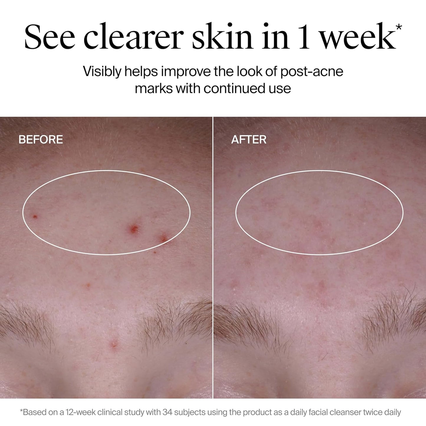 Neutrogena_Evenly_Clear_Acne_Cleanser_with_2%_Salicylic_Acid_&_2%_PHA_Exfoliant,_Gentle_Foaming_Face_Wash_Clears_Clogged_Pores_&_Blackheads_While_Visibly_Fading_Look_of_Post-Acne_Marks,_9.1_fl._oz