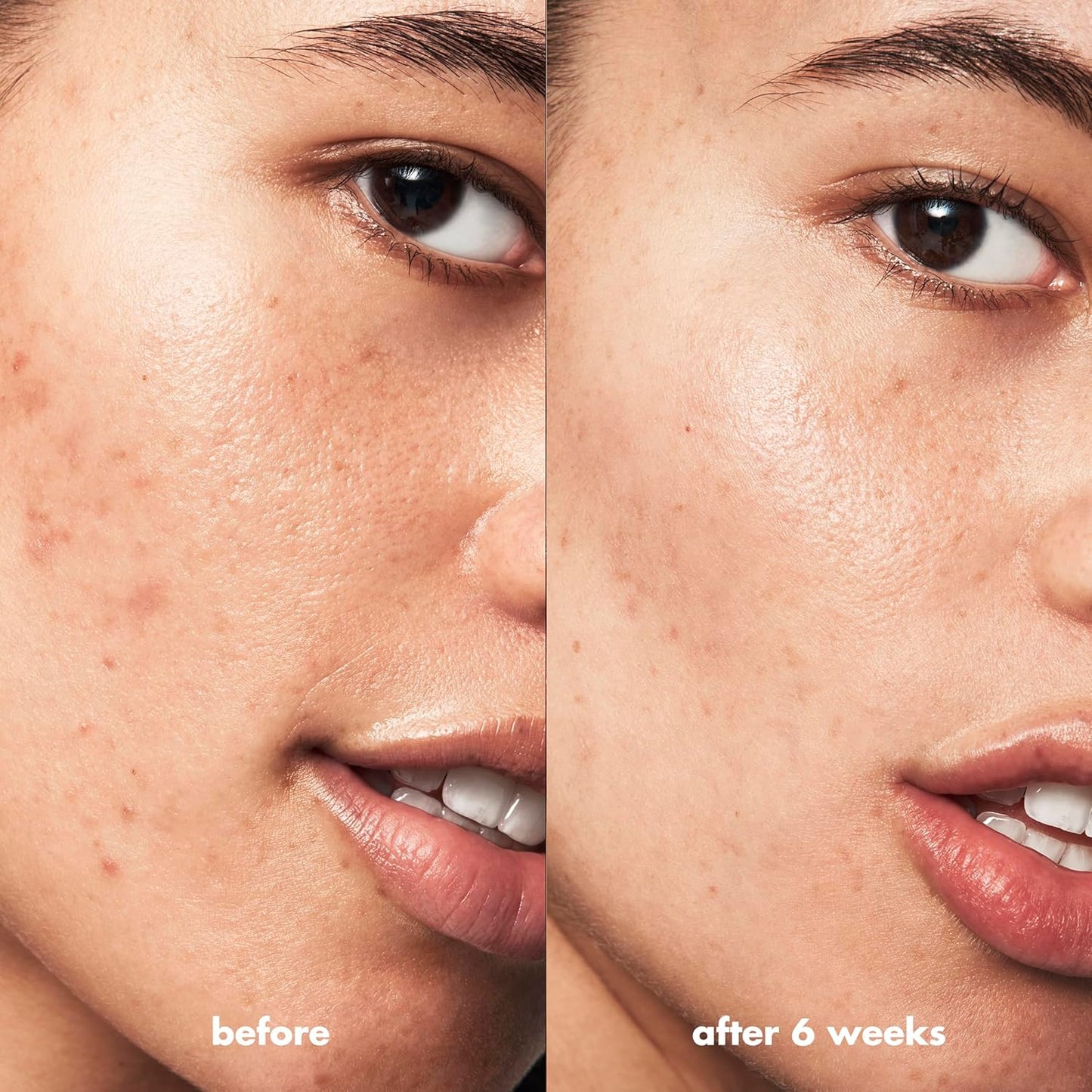 e.l.f._SKIN_Blemish_Breakthrough_Blemish_Fighting_Spot_Gel,_Roll-on_Blemish_Spot_Gel_For_Targeting_&_Treating_Blemishes,_Infused_With_Salicylic_Acid