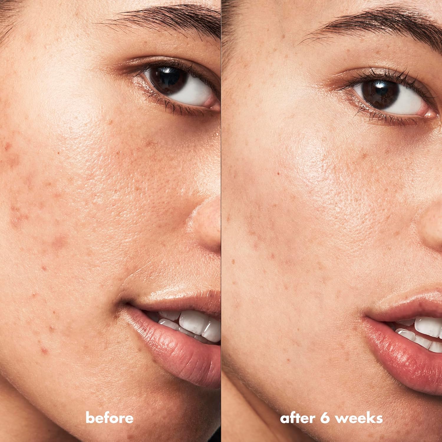 e.l.f._SKIN_Blemish_Breakthrough_Blemish_Fighting_Spot_Gel,_Roll-on_Blemish_Spot_Gel_For_Targeting_&_Treating_Blemishes,_Infused_With_Salicylic_Acid