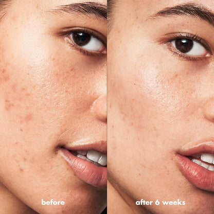 e.l.f._SKIN_Blemish_Breakthrough_Blemish_Fighting_Spot_Gel,_Roll-on_Blemish_Spot_Gel_For_Targeting_&_Treating_Blemishes,_Infused_With_Salicylic_Acid