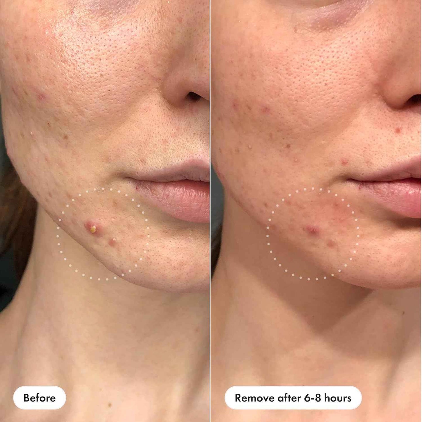 Mighty Patch™ Invisible+ Patch - Daytime Hydrocolloid Acne Pimple Patches for Covering Zits and Blemishes, Ultra Thin Spot Stickers for Face and Skin