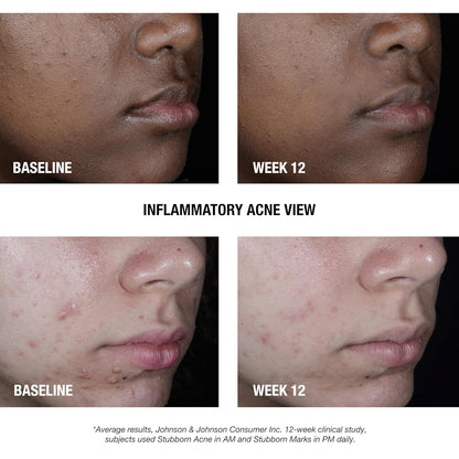 Neutrogena_Stubborn_Acne_AM_Face_Treatment_with_2.5%_Micronized_Benzoyl_Peroxide_Acne_Medication,_Oil-Free_Daily_Facial_Treatment_Reduces_Size_&_Redness_of_Breakouts,_Paraben-Free,_2.0_oz_|_2.5%,_Acne_Medication,_Oil-Free,_Paraben-Free