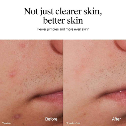 Neutrogena Oil-Free Acne Face Wash with 2% Salicylic Acid for Sensitive Skin – Daily Morning and Evening Facial Cleanser for a Mindful Skincare Ritual