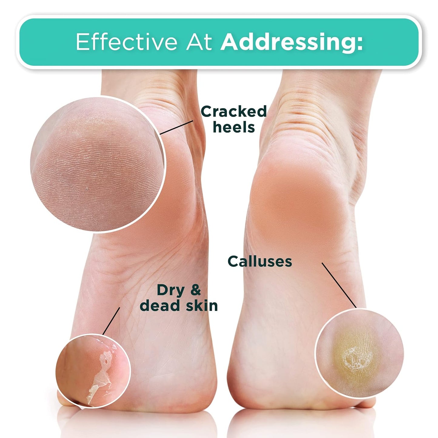 Foot_Peel_Mask_-_2_Pack_of_Regular_Skin_Exfoliating_Foot_Masks_for_Dry,_Cracked_Feet,_Callus,_Dead_Skin_Remover_-_Feet_Peeling_Mask_for_Soft_Feet