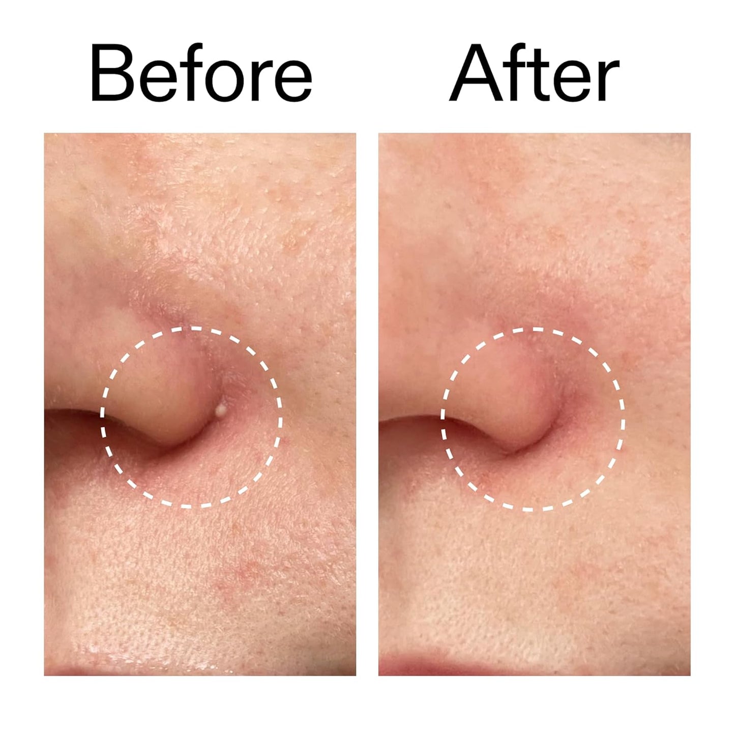 The INKEY List Hydrocolloid Invisible Pimple Patches Overnight Spot Treatment for Calming Nightly Skin Ritual