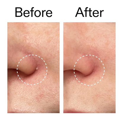 The INKEY List Hydrocolloid Invisible Pimple Patches Overnight Spot Treatment for Calming Nightly Skin Ritual