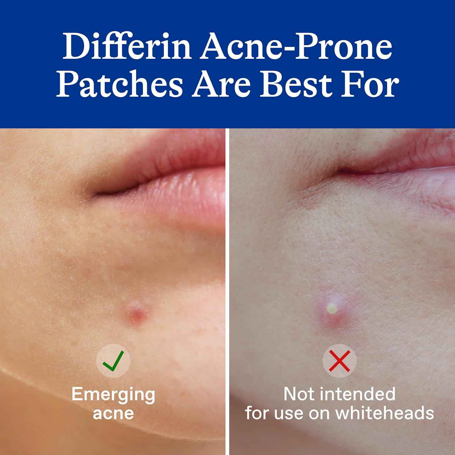 Differin Acne Patches – Daytime Focus Helper, Invisible Wear Under Makeup for Work