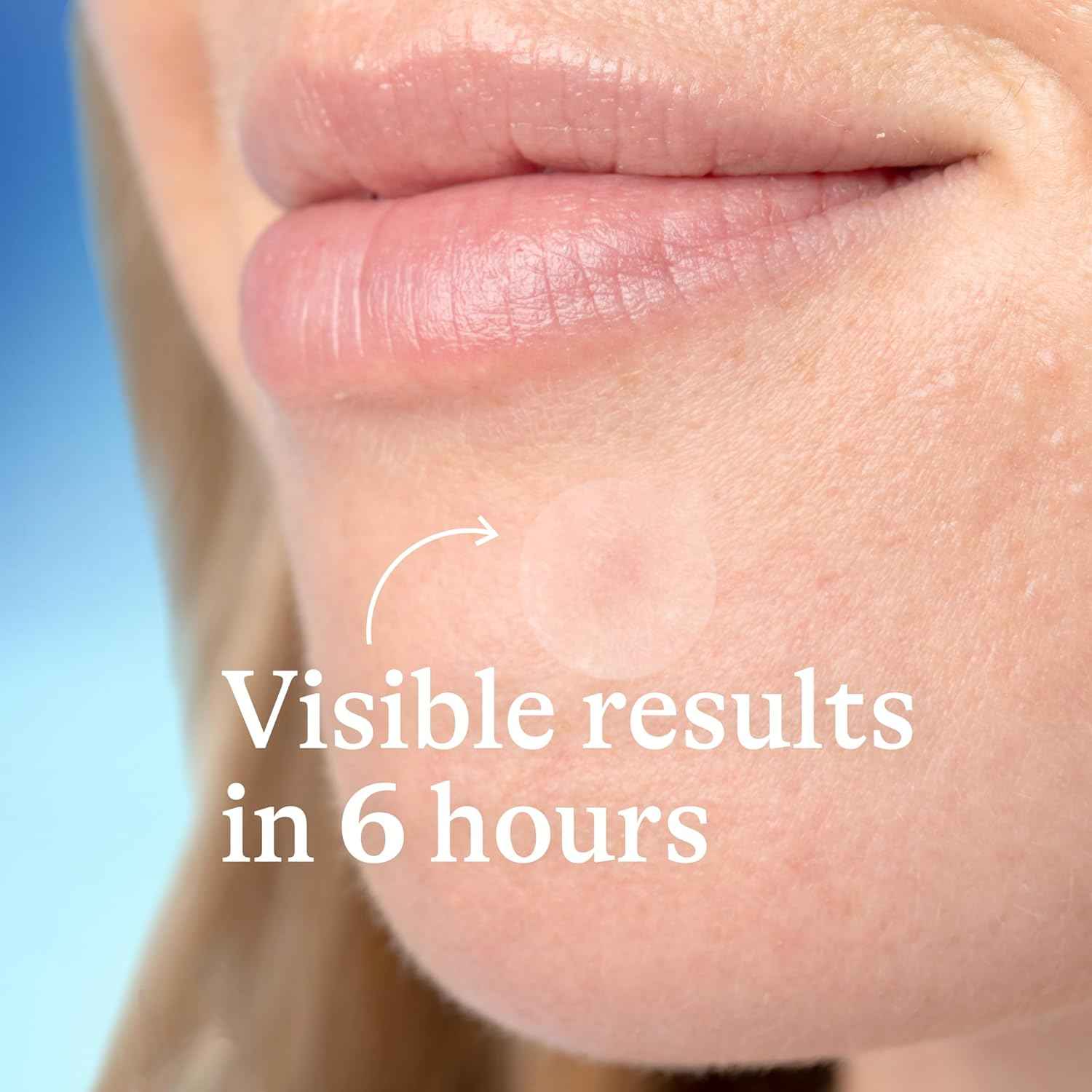 Differin Acne Patches – Daytime Focus Helper, Invisible Wear Under Makeup for Work